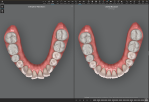 Invisalign Planung durch SayCheeese Zahnärztinnen